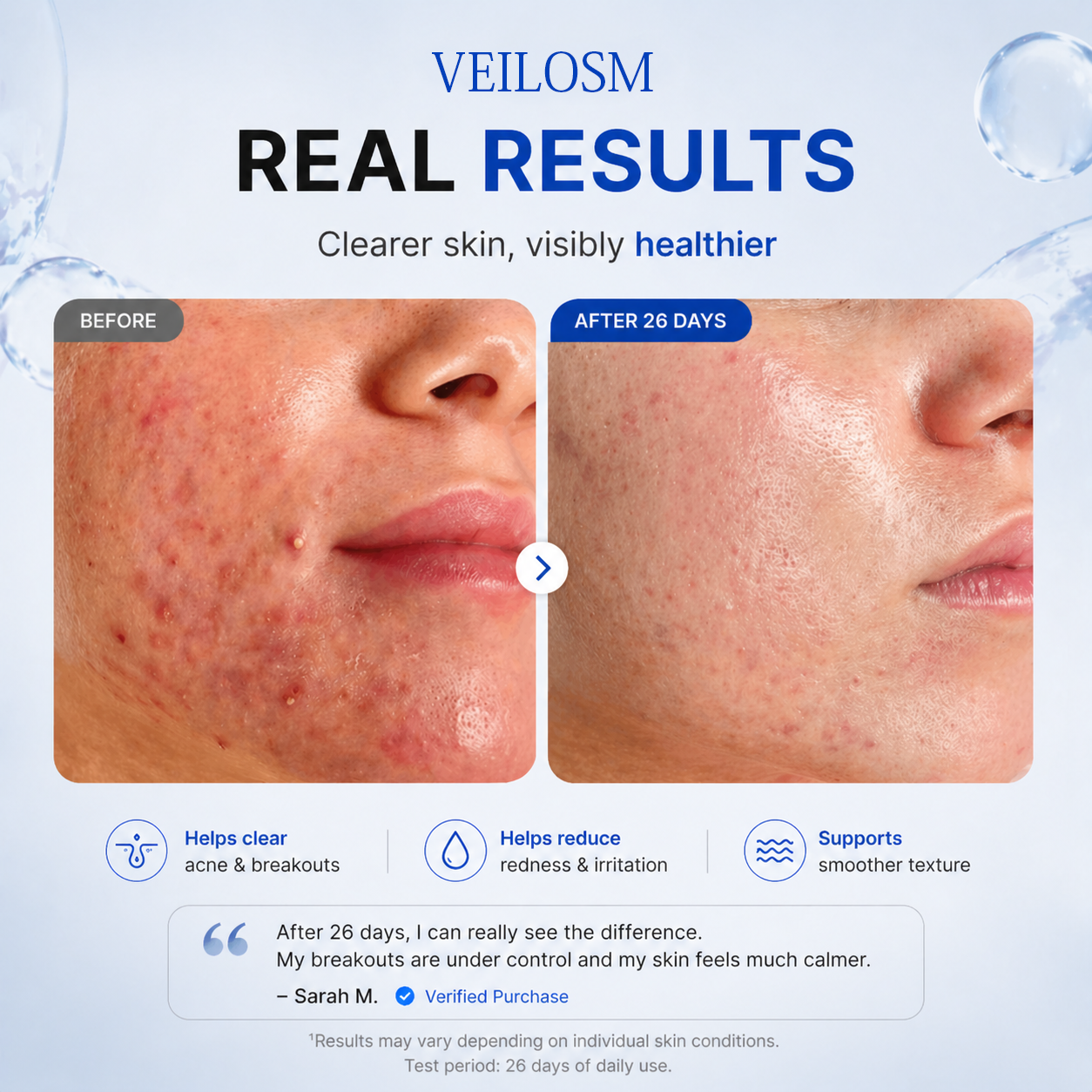 VEILOSM 4-in-1 Bio-Active Protocol: Anti-Acne, Calming, Mark-Fading & Oil-Control