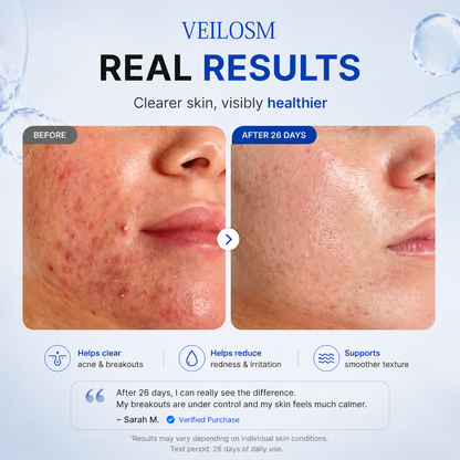 VEILOSM 4-in-1 Bio-Active Protocol: Anti-Acne, Calming, Mark-Fading & Oil-Control