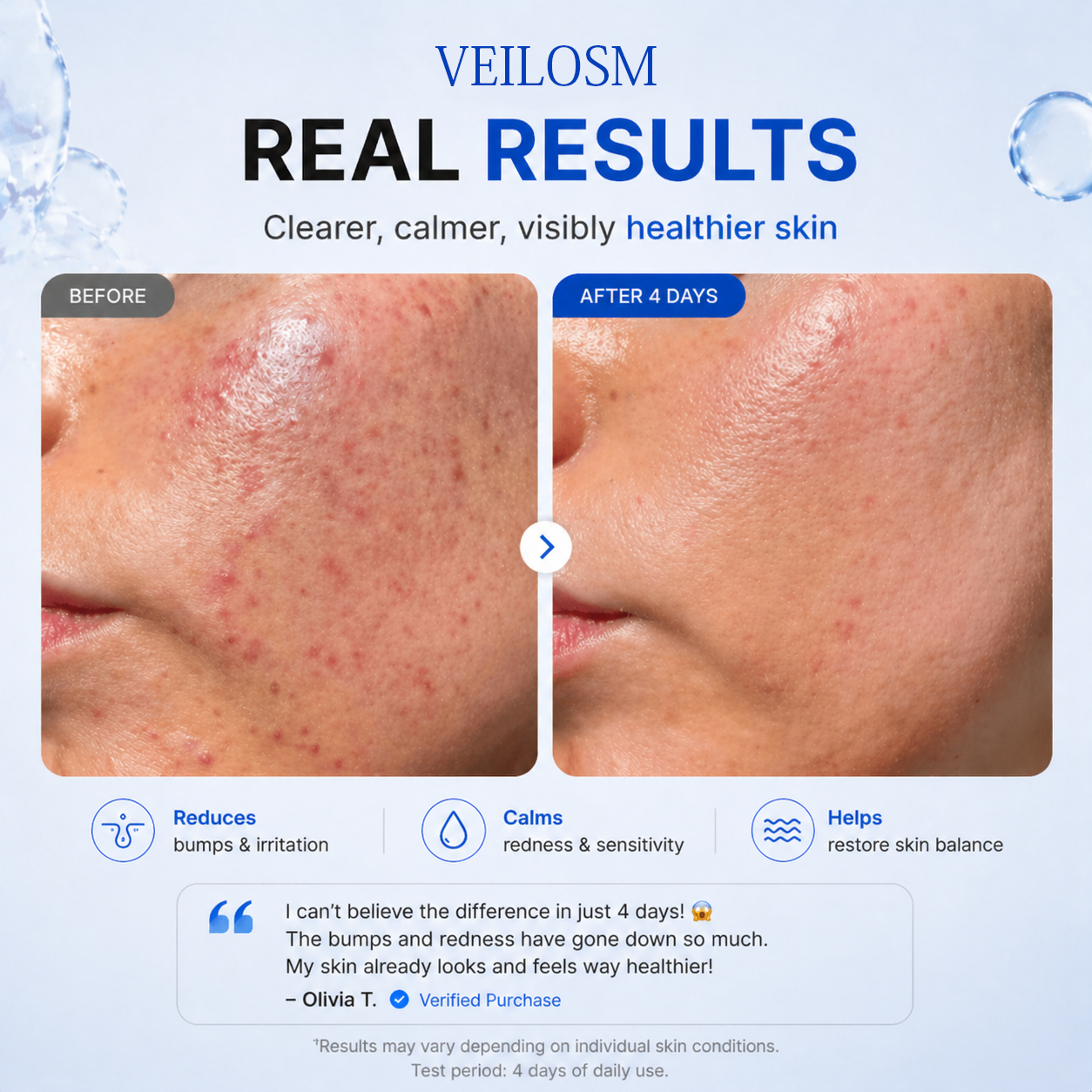 VEILOSM 4-in-1 Bio-Active Protocol: Anti-Acne, Calming, Mark-Fading & Oil-Control