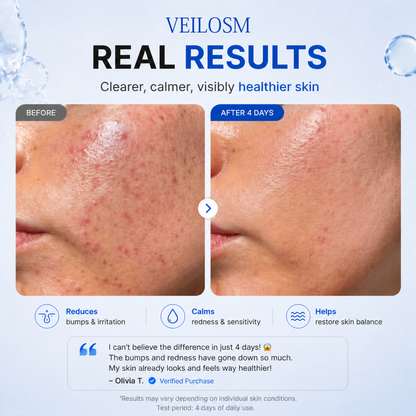 VEILOSM 4-in-1 Bio-Active Protocol: Anti-Acne, Calming, Mark-Fading & Oil-Control