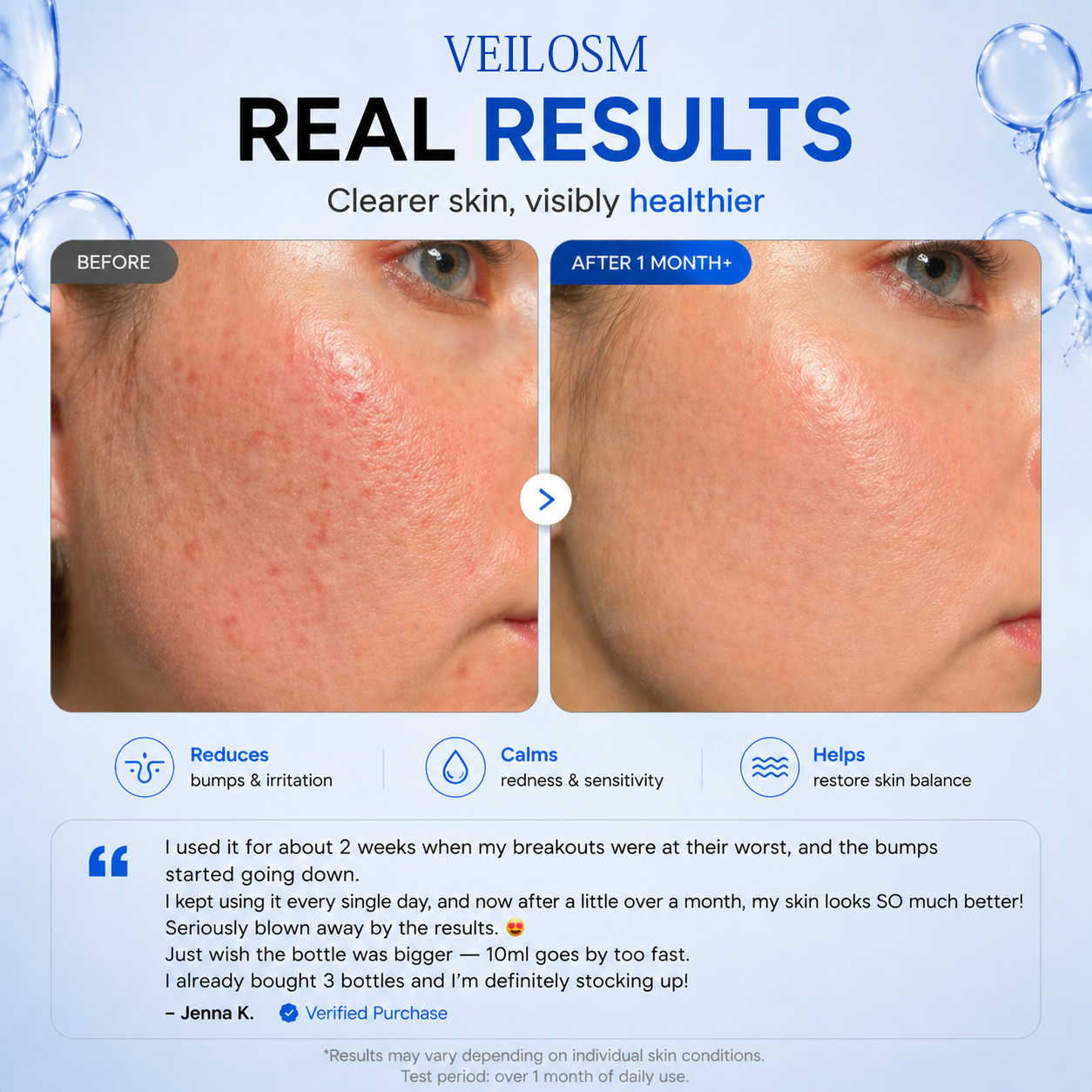 VEILOSM 4-in-1 Bio-Active Protocol: Anti-Acne, Calming, Mark-Fading & Oil-Control