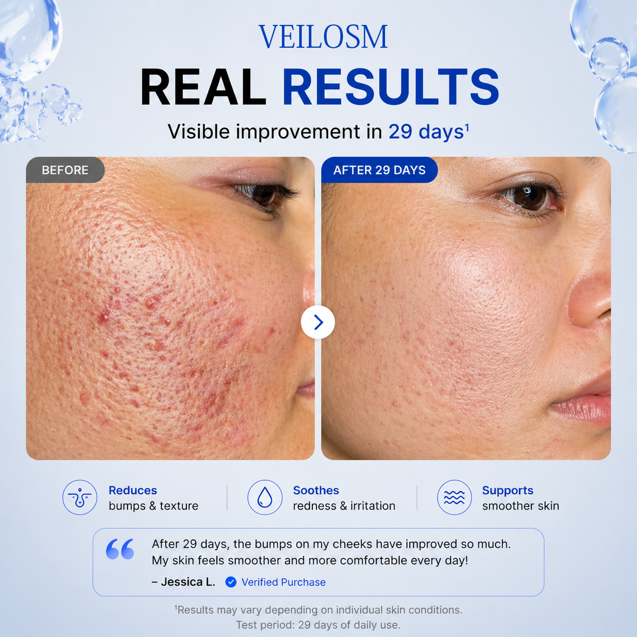 VEILOSM 4-in-1 Bio-Active Protocol: Anti-Acne, Calming, Mark-Fading & Oil-Control