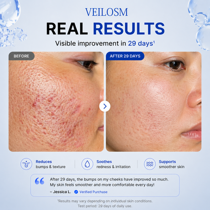 VEILOSM 4-in-1 Bio-Active Protocol: Anti-Acne, Calming, Mark-Fading & Oil-Control